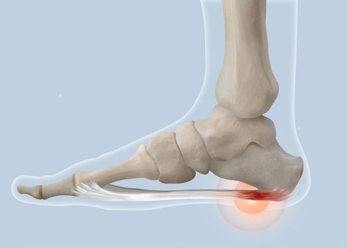 bị đau gót chân khi ngủ dậy